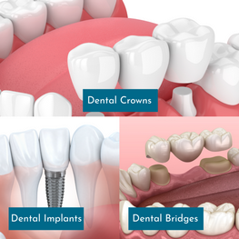 Crowns, Bridges & Dental Implants
