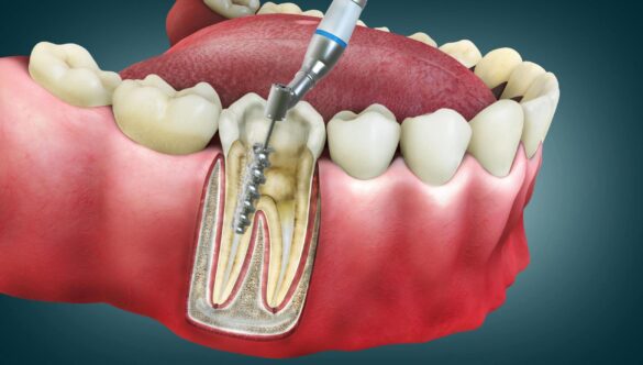 Does Root Canal Cause Pain?