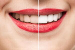 Facts You Need to Know About Teeth Whitening