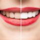 Facts You Need to Know About Teeth Whitening